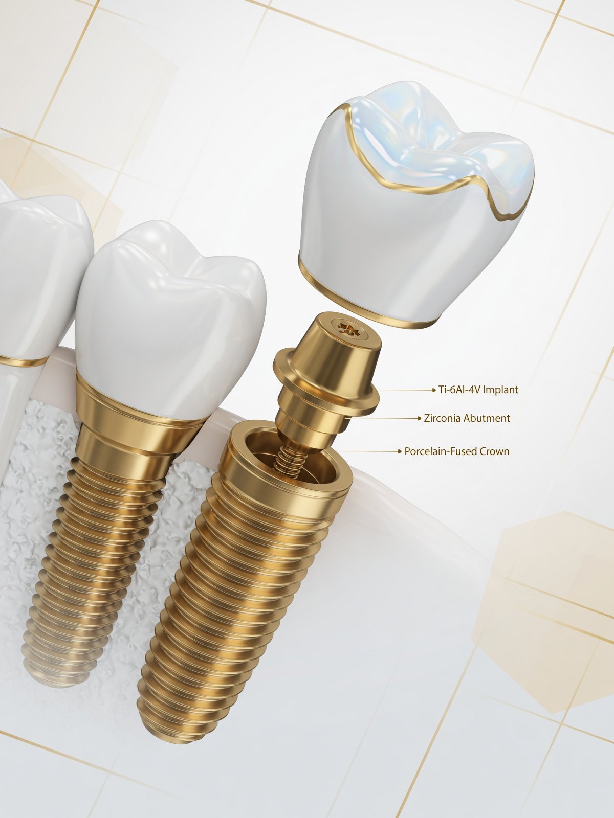 Implante Dentário sem Dor